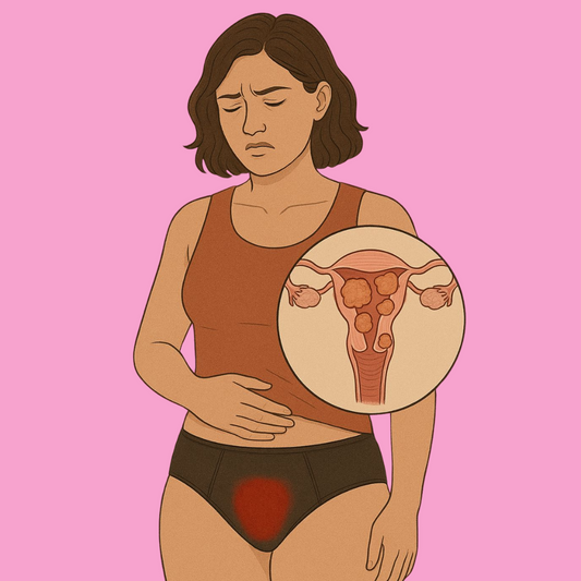 Fibromas uterinos: ¿cómo los calzones menstruales pueden ayudar ante estos diagnósticos?