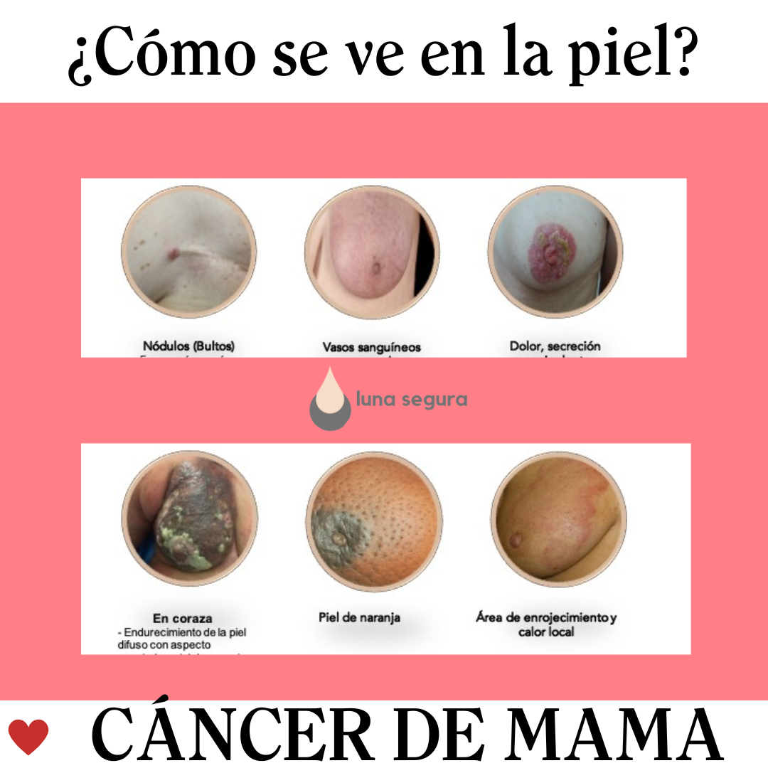 Cáncer de Mama en México: Estadísticas y Estrategias de Prevención