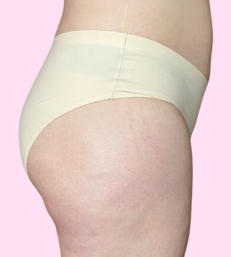 Portia (Bonded Hi Cut) - Moderado Invisible